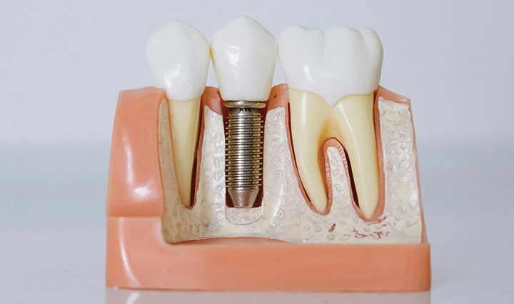 Root Canal Treatment