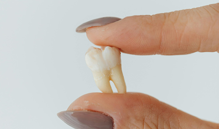 Wisdom Teeth Removal